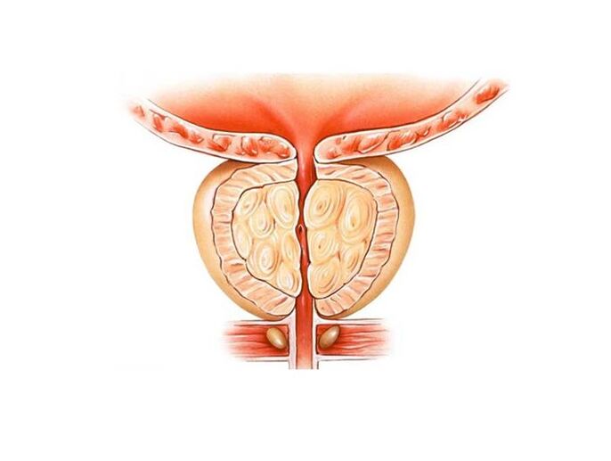 inflamação da próstata