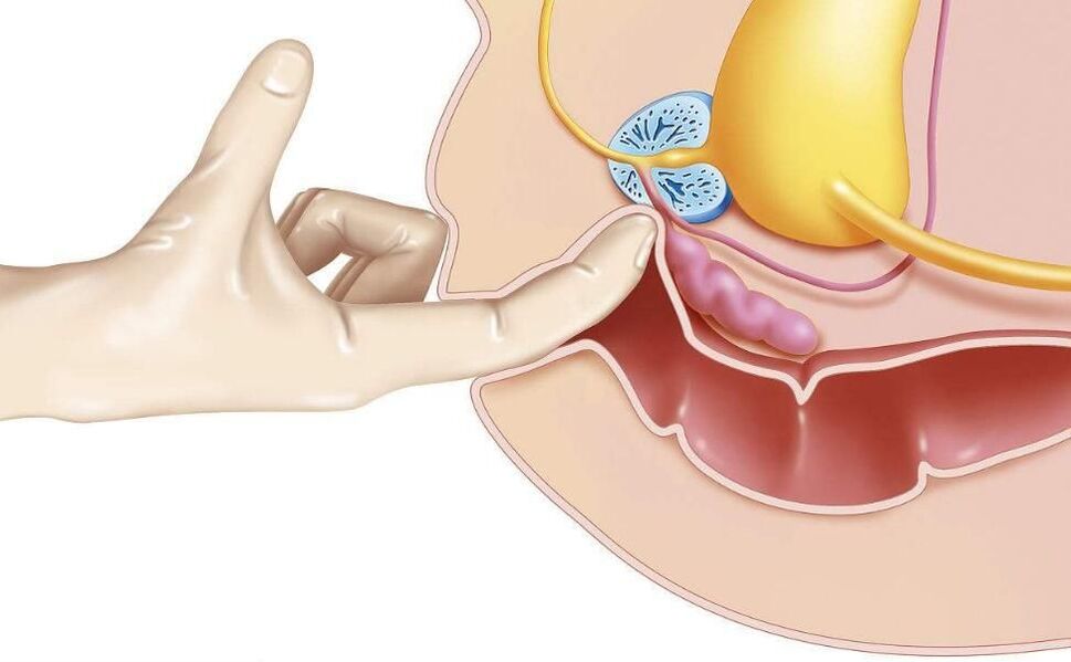 massagem de próstata para tratamento de prostatite